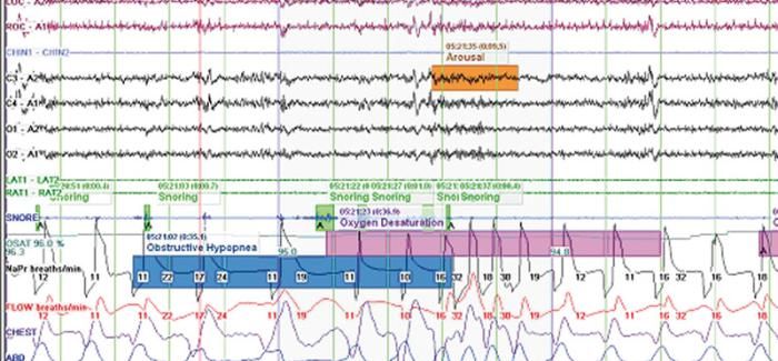 Natus Brain Monitor EEG / PSG Combo Sistemleri